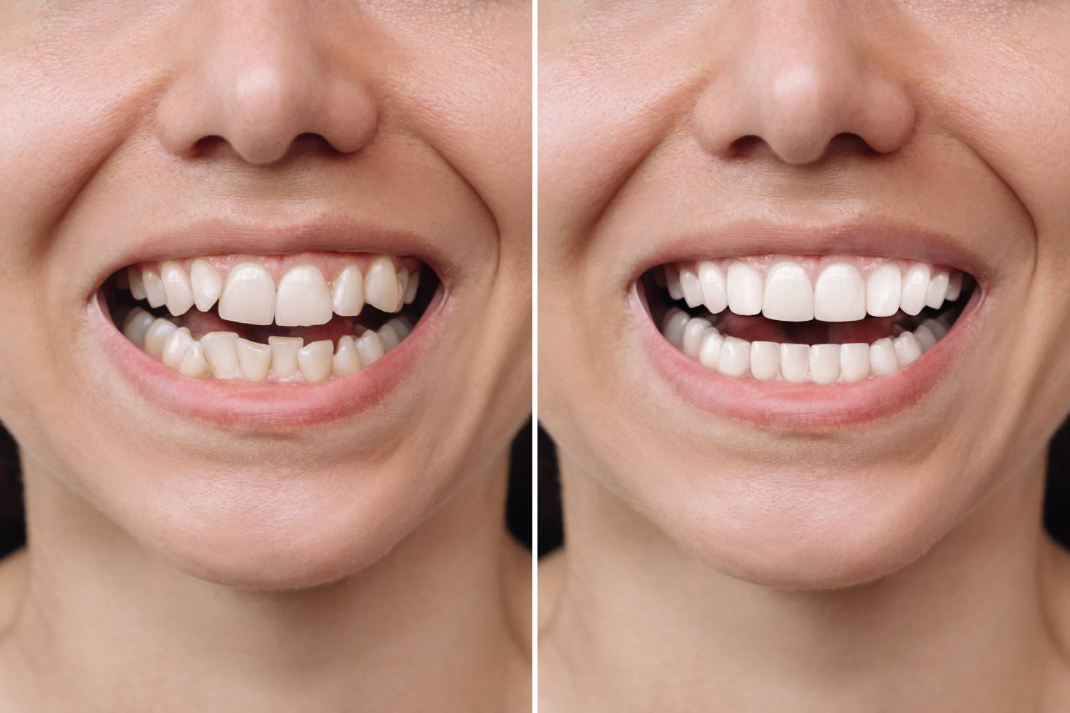 8 Typical Causes for Crooked Teeth